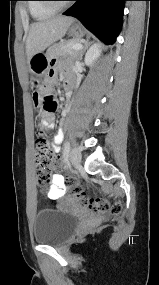 Acute uncomplicated appendicitis (Radiopaedia 61374-69304 Sagittal C+ portal venous phase 42).jpg