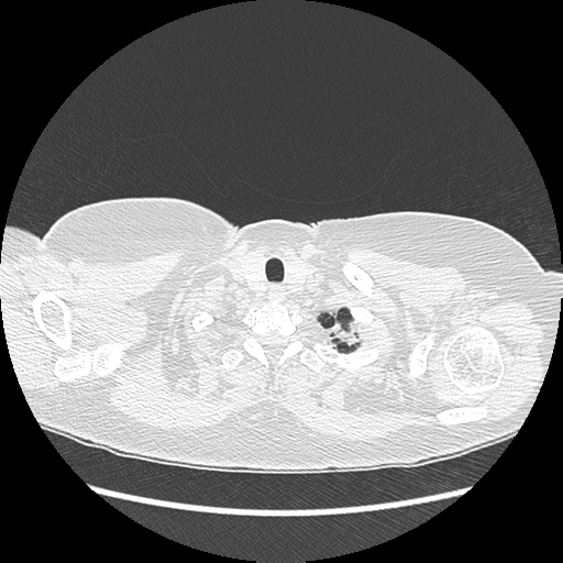 Adenocarcinoma in situ of lung (Radiopaedia 38685-40829 B 13).png