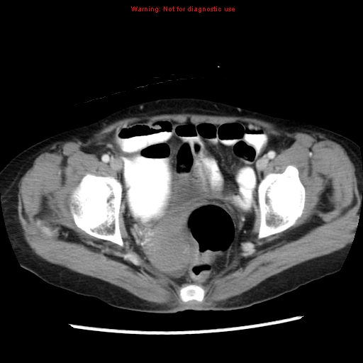File:Adenocarcinoma of the colon (Radiopaedia 8191-9039 Axial liver window 68).jpg