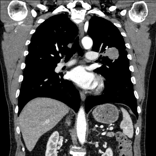 Adenocarcinoma of the lung (Radiopaedia 59871-67325 Coronal C+ arterial phase 39).jpg