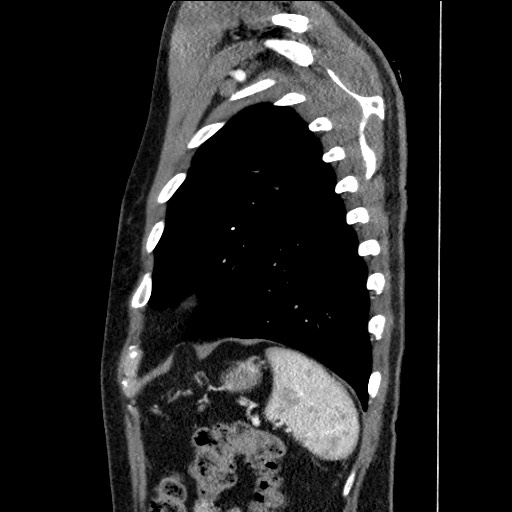 Adenocarcinoma of the lung (Radiopaedia 59871-67325 Sagittal C+ arterial phase 86).jpg