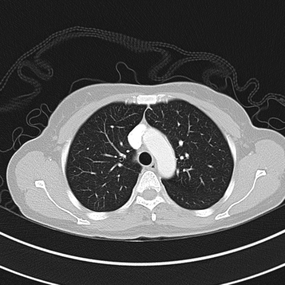 File:Adenocystic carcinoma of the trachea (Radiopaedia 47677-52525 Axial lung window 42).jpg