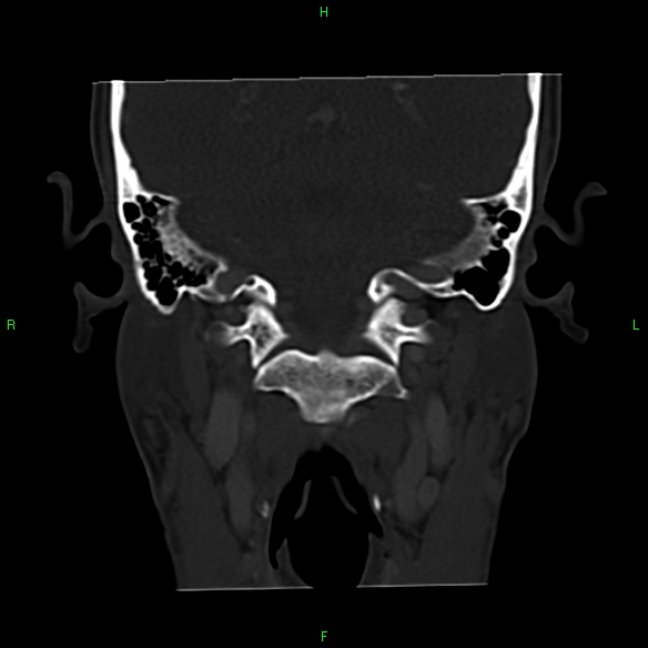 File:Adenoid cystic carcinoma of hard palate (Radiopaedia 26137-26273 Coronal bone window 27).jpg