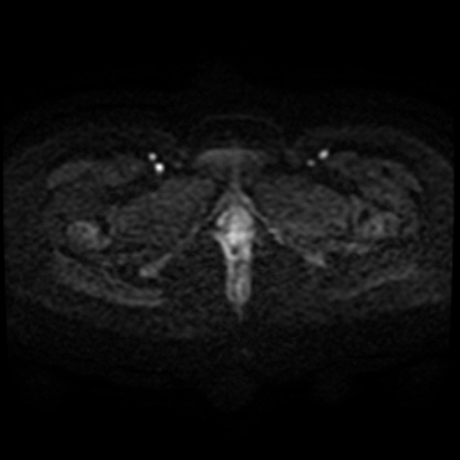 Adenoma malignum of cervix (Radiopaedia 66441-75705 Axial DWI 76).jpg