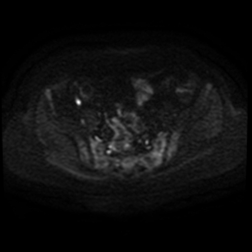 Adenoma malignum of cervix (Radiopaedia 66441-75705 Axial DWI 79).jpg