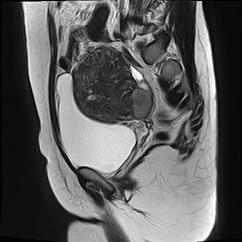 File:Adenomyosis - ovarian endometriomas (Radiopaedia 67031-76350 Sagittal T2 9).jpg