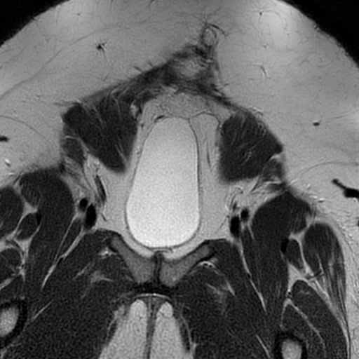 File:Adenomyosis within a didelphys uterus (Radiopaedia 70175-80215 Coronal T2 5).jpg