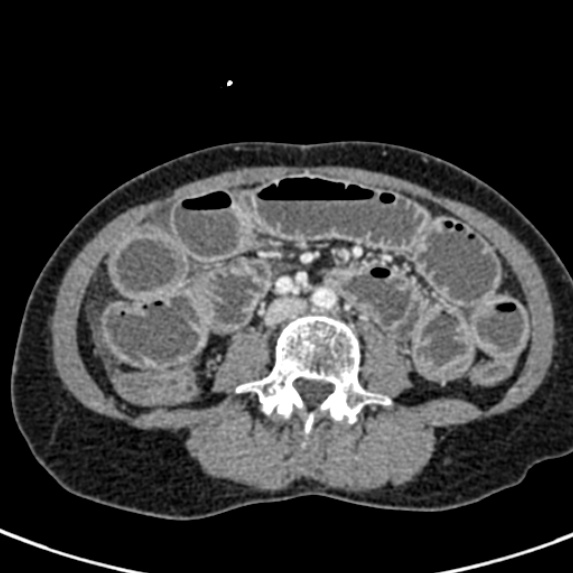 File:Adhesional small bowel obstruction (Radiopaedia 48397-53305 Axial C+ portal venous phase 49).jpg