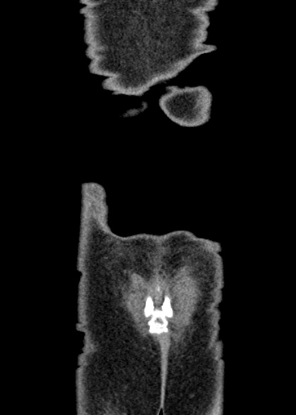 Adhesional small bowel obstruction (Radiopaedia 48397-53305 Coronal C+ portal venous phase 348).jpg