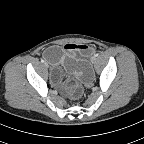 Adhesional small bowel obstruction (Radiopaedia 52107-57980 Axial C+ portal venous phase 109).jpg