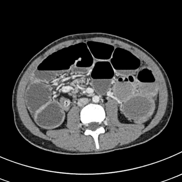 File:Adhesional small bowel obstruction (Radiopaedia 52107-57980 Axial C+ portal venous phase 64).jpg