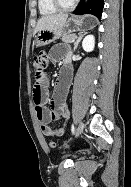 Adhesional small bowel obstruction (Radiopaedia 58900-66131 Sagittal C+ portal venous phase 153).jpg
