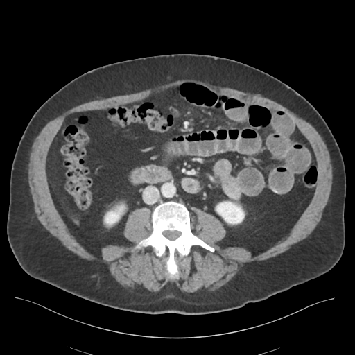 Adhesions within abdominal wall hernia (Radiopaedia 58283-65394 Axial C+ portal venous phase 44).png