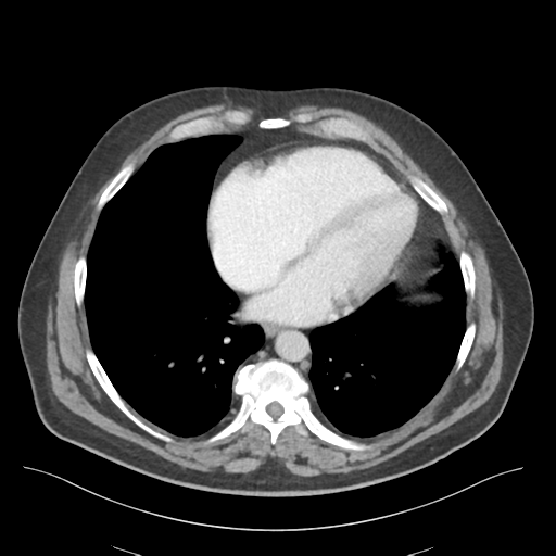 File:Adhesions within abdominal wall hernia (Radiopaedia 58283-65394 Axial C+ portal venous phase 6).png