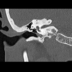 File:Adhesive chronic otitis media (Radiopaedia 14270-14148 Coronal bone window - right 11).jpg