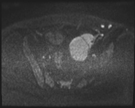 Adnexal multilocular cyst (O-RADS US 3- O-RADS MRI 3) (Radiopaedia 87426-103754 Axial DWI 71).jpg