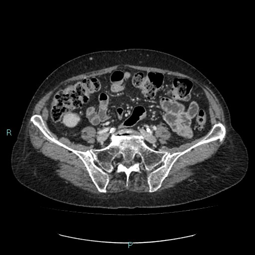 File:Adrenal collision tumor (ACT) (Radiopaedia 48462-53379 Axial C+ portal venous phase 43).jpg