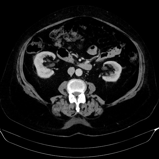File:Adrenal cortical carcinoma (Radiopaedia 64017-72769 Axial C+ portal venous phase 34).jpg