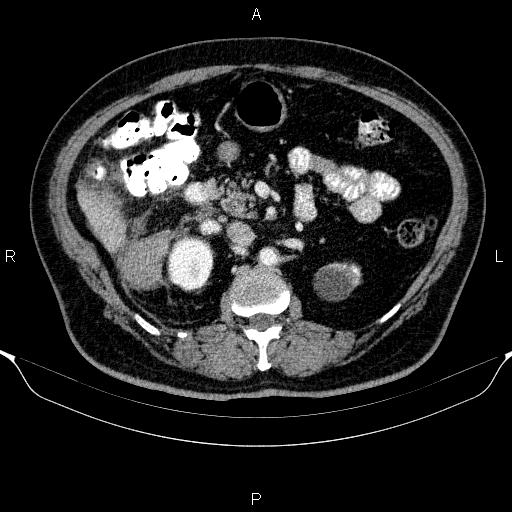 Adrenal hemorrhage (Radiopaedia 62622-70916 Axial C+ portal venous phase 74).jpg