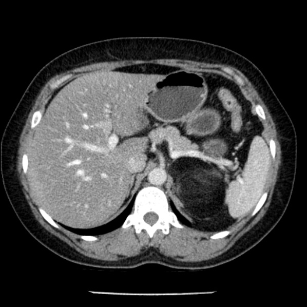 Adrenal myelolipoma (Radiopaedia 43401-46759 Axial C+ portal venous phase 21).jpg