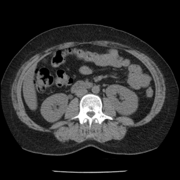 Adrenal myelolipoma (Radiopaedia 43401-46759 Axial non-contrast 43).jpg