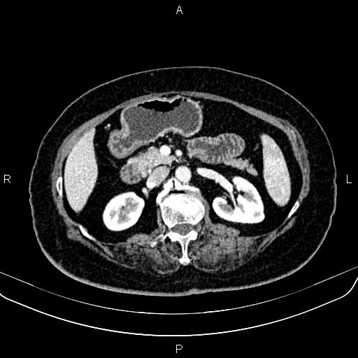 Adrenal myelolipoma (Radiopaedia 82742-96986 Axial renal cortical phase 70).jpg