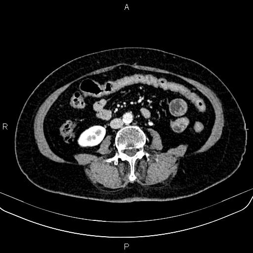 File:Adrenal myelolipoma (Radiopaedia 82742-96986 Axial renal cortical phase 99).jpg