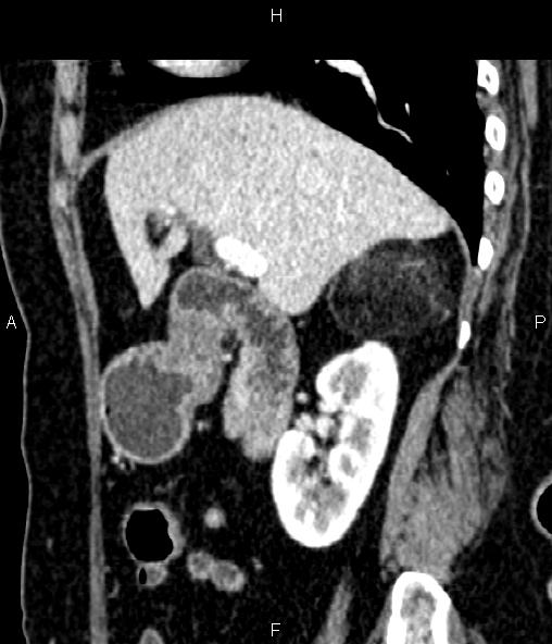 Adrenal myelolipoma (Radiopaedia 82742-96986 Sagittal renal cortical phase 41).jpg