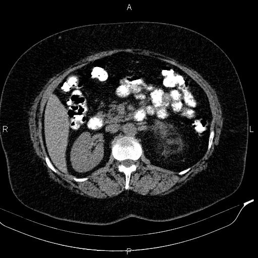 Adrenal myelolipoma (Radiopaedia 84319-99617 Axial With oral contrast 88).jpg