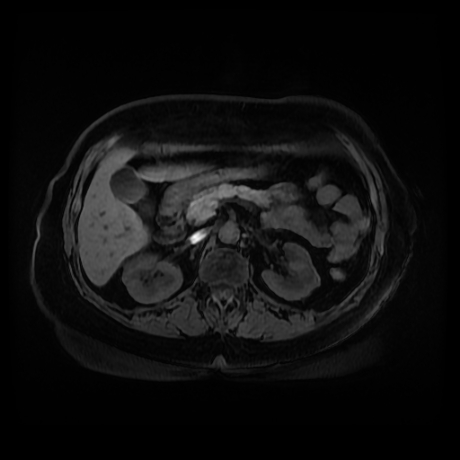 Adrenal myelolipoma - MRI (Radiopaedia 83249-97646 Axial T1 fat sat 37).jpg