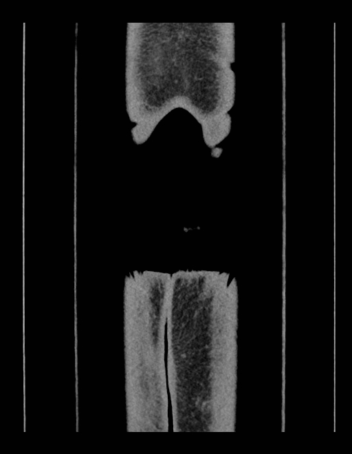 Adrenal myelolipoma - bilateral (Radiopaedia 74805-85810 Coronal C+ portal venous phase 24).jpg