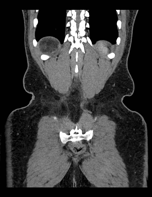 Adrenal myelolipoma - bilateral (Radiopaedia 74805-85810 Coronal C+ portal venous phase 67).jpg