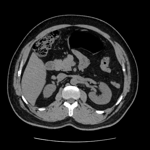 Adrenal myelolipoma and beaver tail liver (Radiopaedia 86201-102193 Axial non-contrast 180).jpg