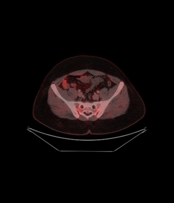 Adrenocortical carcinoma (Radiopaedia 80134-93440 ِAxial 223).jpg