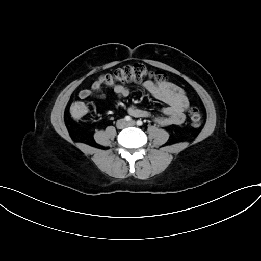 Adrenocortical carcinoma (Radiopaedia 87281-103569 Axial C+ portal venous phase 54).jpg