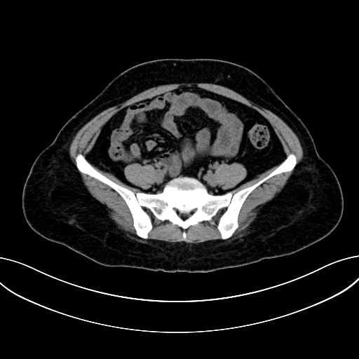 Adrenocortical carcinoma (Radiopaedia 87281-103569 Axial non-contrast 63).jpg