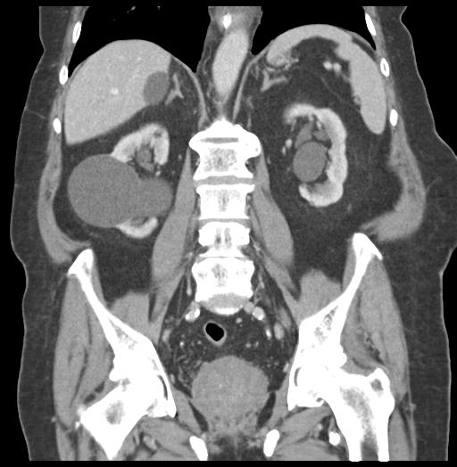 Adult ileal intussusception with secondary obstruction (Radiopaedia 30395-31051 Coronal C+ portal venous phase 40).jpg