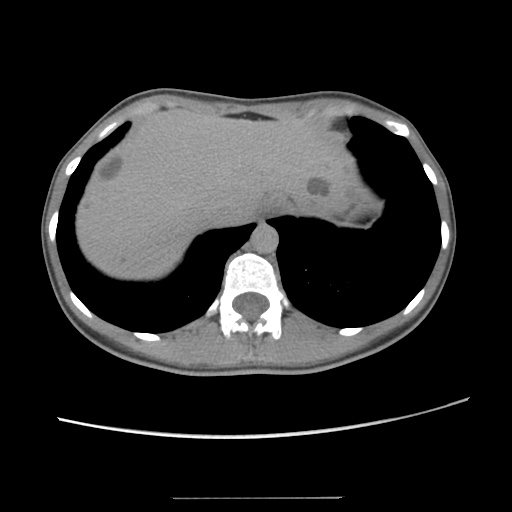 Adult polycystic kidney disease (Radiopaedia 48845-53876 Axial renal excretory phase 20).jpg