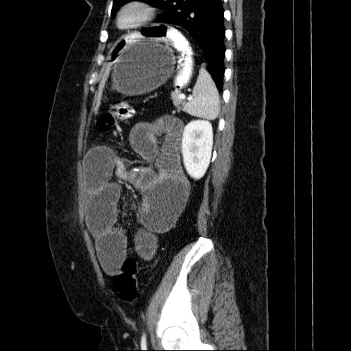 File:Afferent loop syndrome - secondary to incarcerated trocar site hernia (Radiopaedia 82959-97305 Sagittal C+ portal venous phase 41).jpg