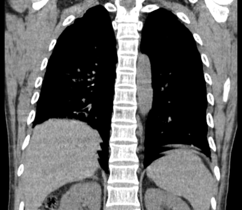 Airway foreign body in adult (Radiopaedia 85907-101779 Coronal liver window 194).jpg