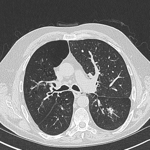 Allergic bronchopulmonary aspergillosis (Radiopaedia 44760-48571 Axial lung window 27).png
