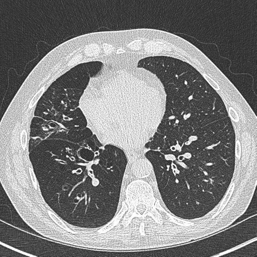 File:Allergic bronchopulmonary aspergillosis (Radiopaedia 44760-48571 Axial lung window 42).png