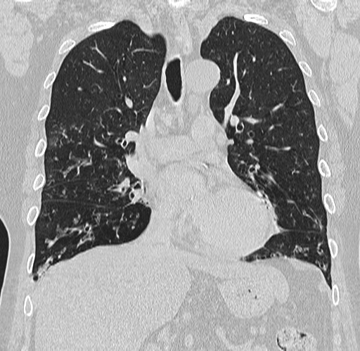 Alpha-1-antitrypsin deficiency (Radiopaedia 72058-82557 Coronal lung window 35).jpg