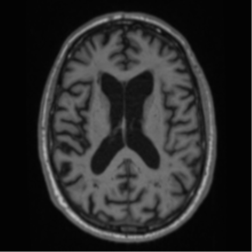 Alzheimer's disease- with Gerstmann syndrome and dressing apraxia (Radiopaedia 54882-61150 Axial T1 44).png
