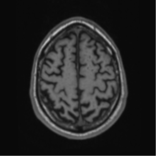 Alzheimer's disease- with Gerstmann syndrome and dressing apraxia (Radiopaedia 54882-61150 Axial T1 61).png