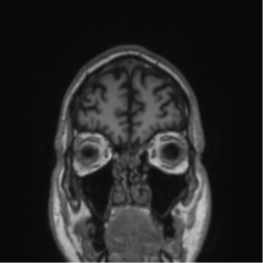 Alzheimer's disease- with Gerstmann syndrome and dressing apraxia (Radiopaedia 54882-61150 Coronal T1 79).png