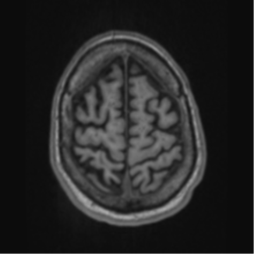 Alzheimer's disease- with apraxia (Radiopaedia 54763-61011 Axial T1 64).png