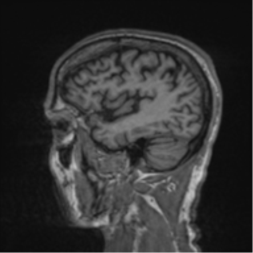 File:Alzheimer's disease- with apraxia (Radiopaedia 54763-61011 Sagittal T1 55).png