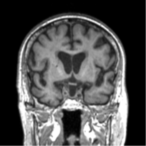 File:Alzheimer disease and cerebral amyloid angiopathy (Radiopaedia 64234-73011 Coronal T1 42).png