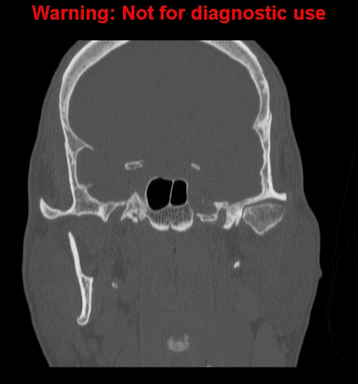 File:Ameloblastoma (Radiopaedia 13276-13280 Coronal non-contrast 19).jpg